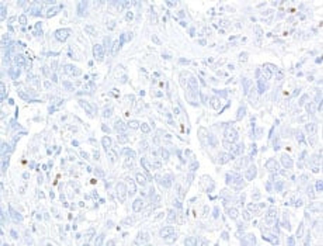Detection of human FOXP3 in FFPE breast carcinoma by immunohistochemistry.