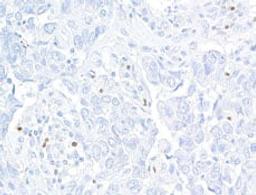 Detection of human FOXP3 in FFPE breast carcinoma by immunohistochemistry.