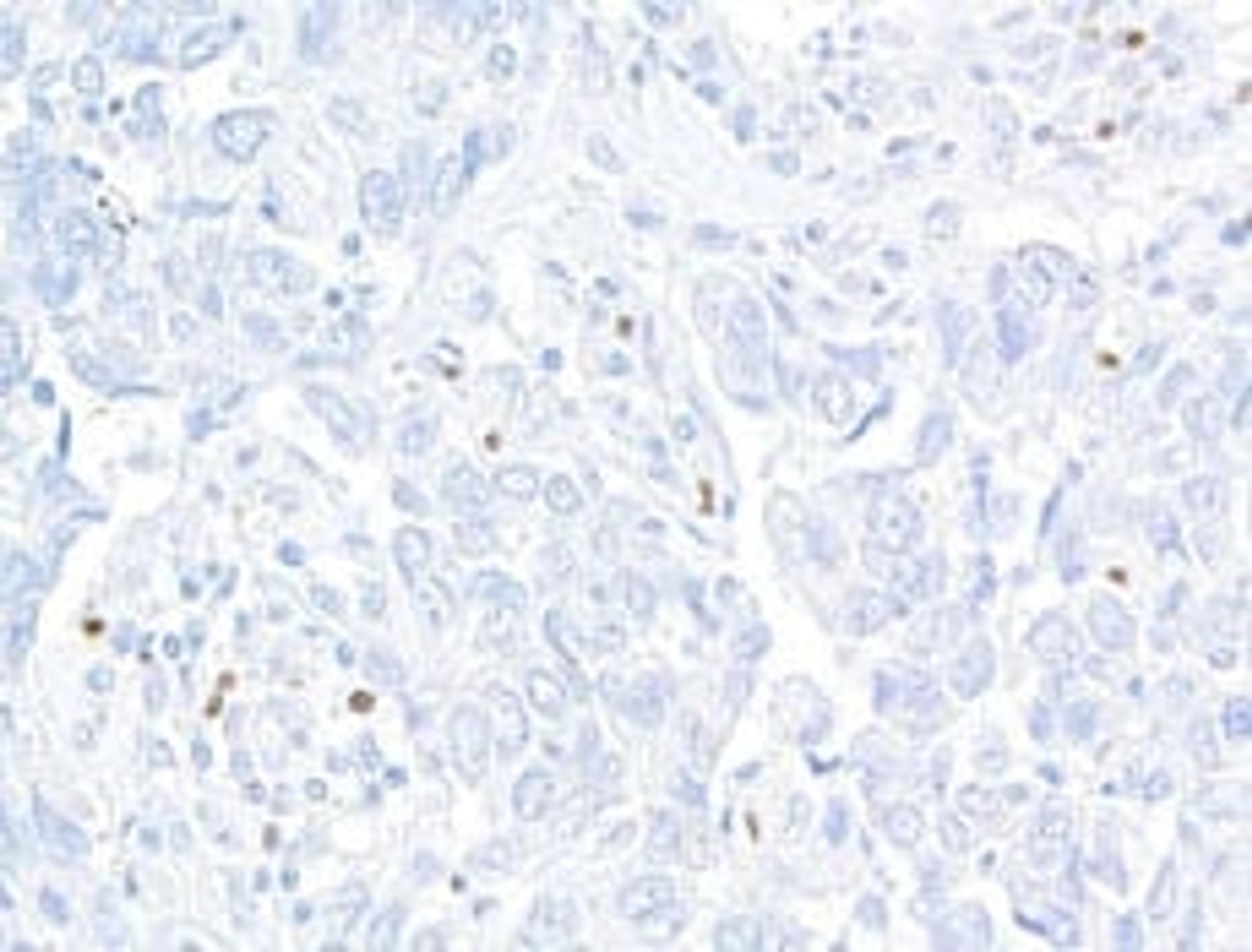 Detection of human FOXP3 in FFPE breast carcinoma by immunohistochemistry.