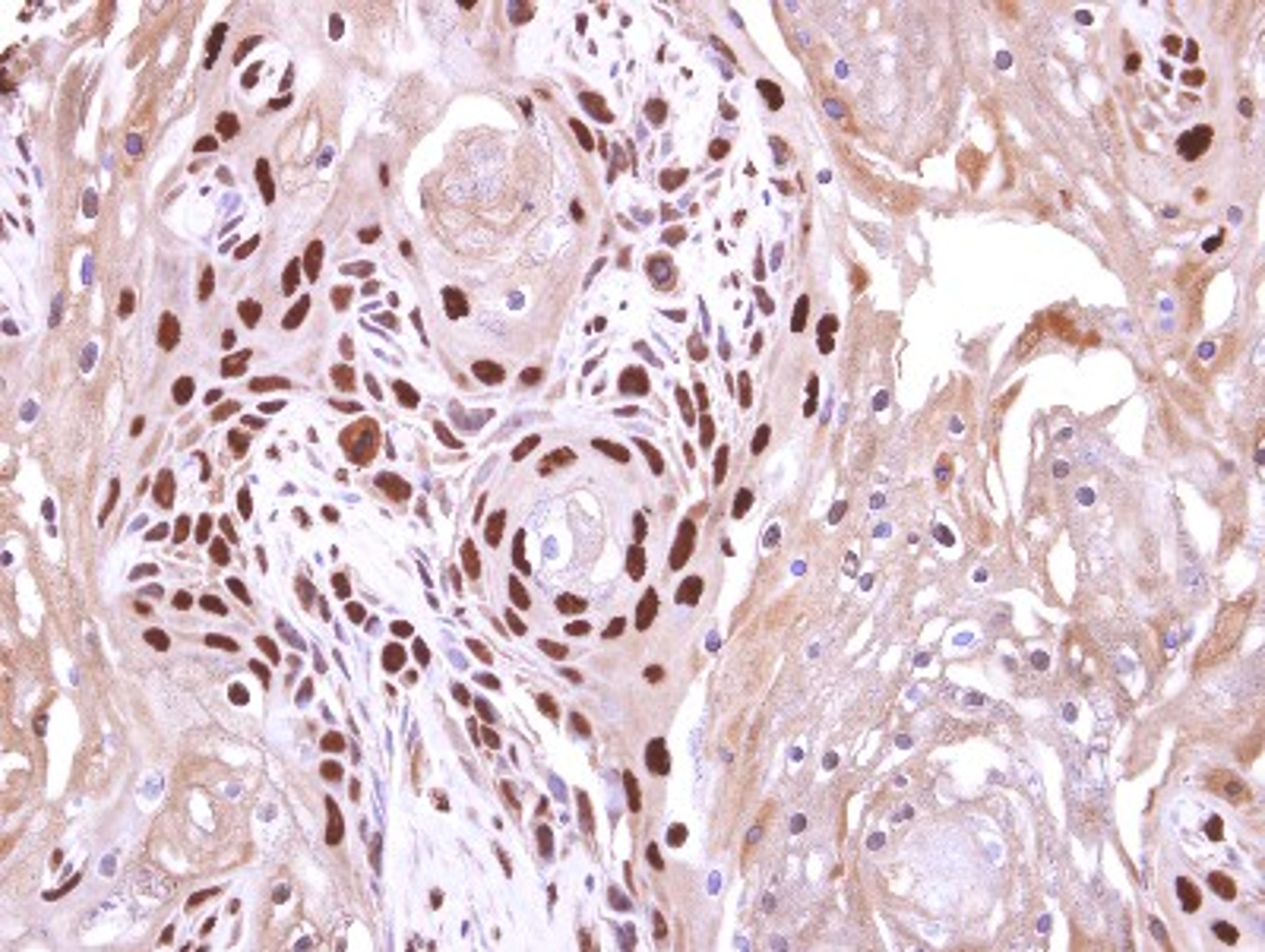 Immunohistochemistry-Paraffin: WDR62 Antibody [NBP2-20897] - Wdr62 antibody detects Wdr62 protein at nucleus on Ca922 oral cancer xenograft by immunohistochemical analysis. Sample: Paraffin-embedded Ca922 oral cancer xenograft. Wdr62 antibody dilution: 1:500.