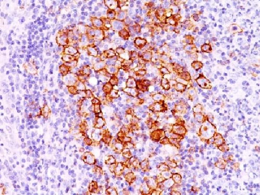 Immunohistochemical staining of human Hodgkin's lymphoma tissue using TNFRSF8 antibody