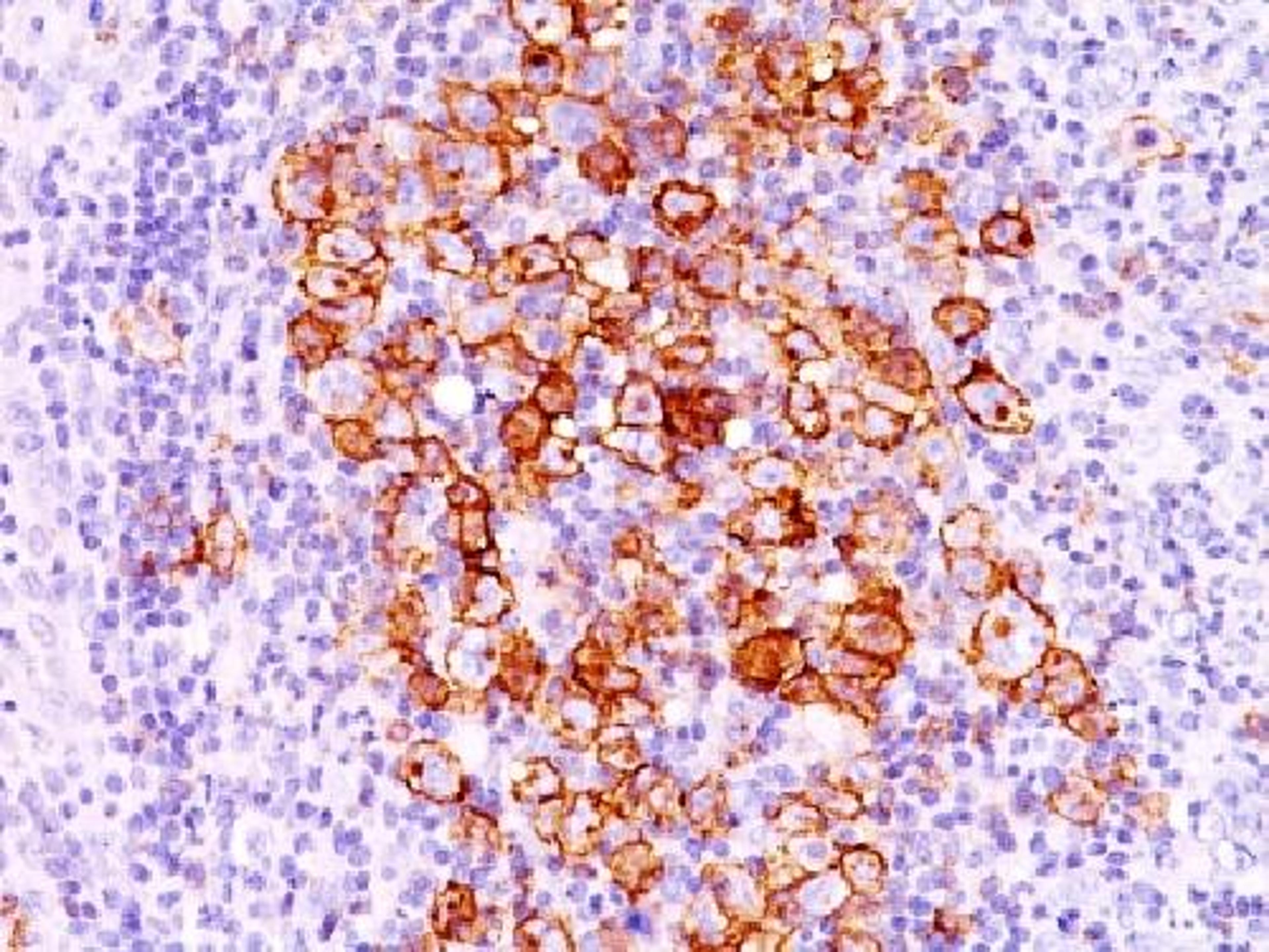 Immunohistochemical staining of human Hodgkin's lymphoma tissue using TNFRSF8 antibody