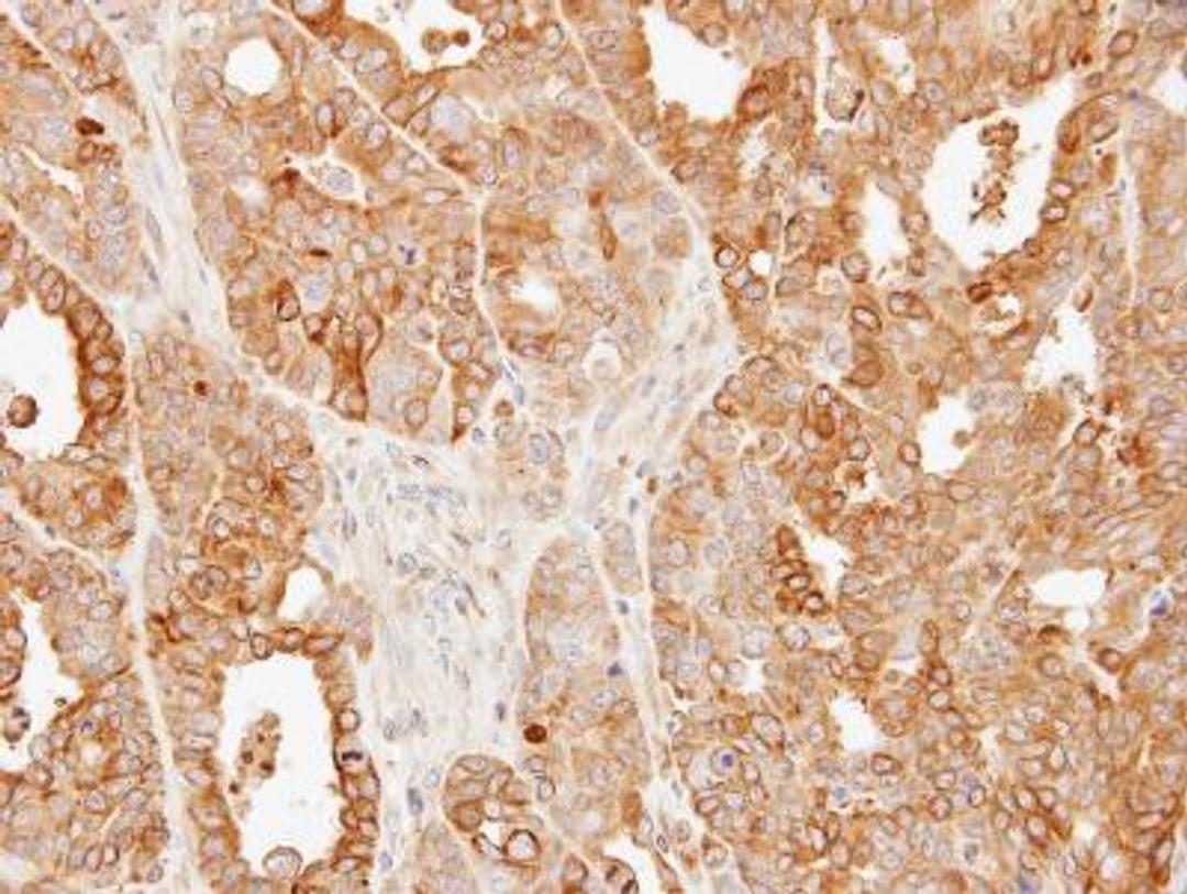 Immunohistochemistry-Paraffin: SLC25A13 Antibody [NBP1-33380] - Paraffin-embedded N87 xenograft, using antibody at 1:500 dilution.