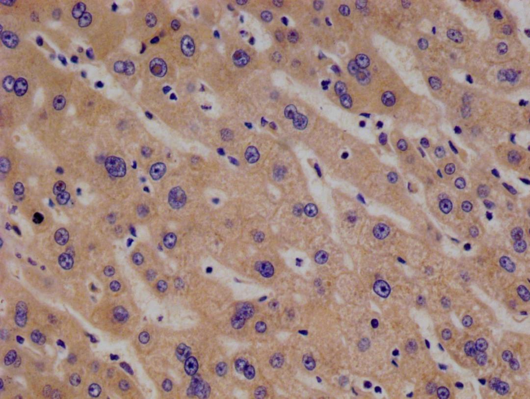 IHC image of CSB-RA169000A0HU diluted at 1:100 and staining in paraffin-embedded human liver cancer performed on a Leica BondTM system. After dewaxing and hydration, antigen retrieval was mediated by high pressure in a citrate buffer (pH 6.0). Section was blocked with 10% normal goat serum 30min at RT. Then primary antibody (1% BSA) was incubated at 4°C overnight. The primary is detected by a Goat anti-rabbit polymer IgG labeled by HRP and visualized using 0.05% DAB.