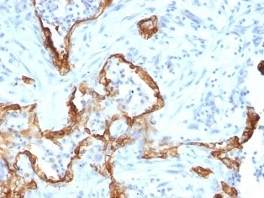 Formalin-fixed, paraffin-embedded human lung carcinoma stained with Cytokeratin 8 antibody (SPM192).