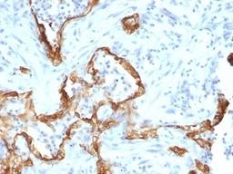 Formalin-fixed, paraffin-embedded human lung carcinoma stained with Cytokeratin 8 antibody (SPM192).