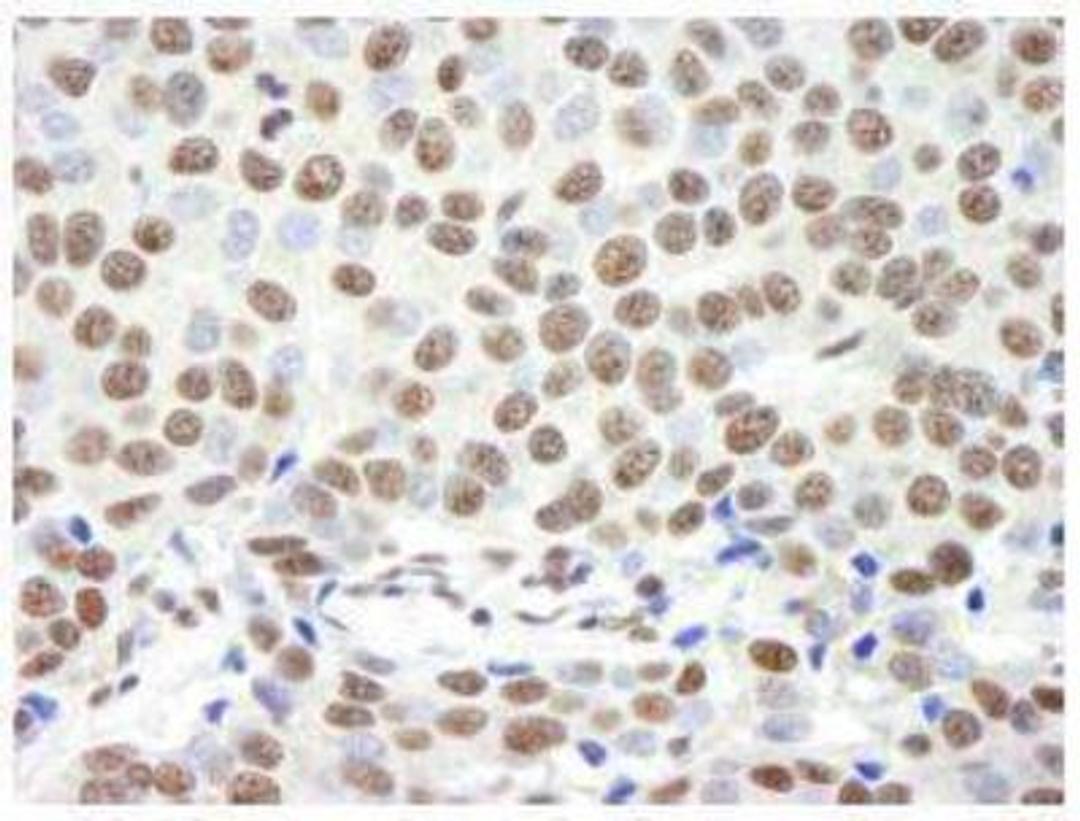 Immunohistochemistry-Paraffin: Timeless Antibody [NB100-40853] - FFPE section of human breast carcinoma.  Affinity purified rabbit anti-Timeless used at a dilution of 1:250. Detection: DAB staining using Immunohistochemistry Accessory Kit