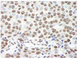 Immunohistochemistry-Paraffin: Timeless Antibody [NB100-40853] - FFPE section of human breast carcinoma.  Affinity purified rabbit anti-Timeless used at a dilution of 1:250. Detection: DAB staining using Immunohistochemistry Accessory Kit