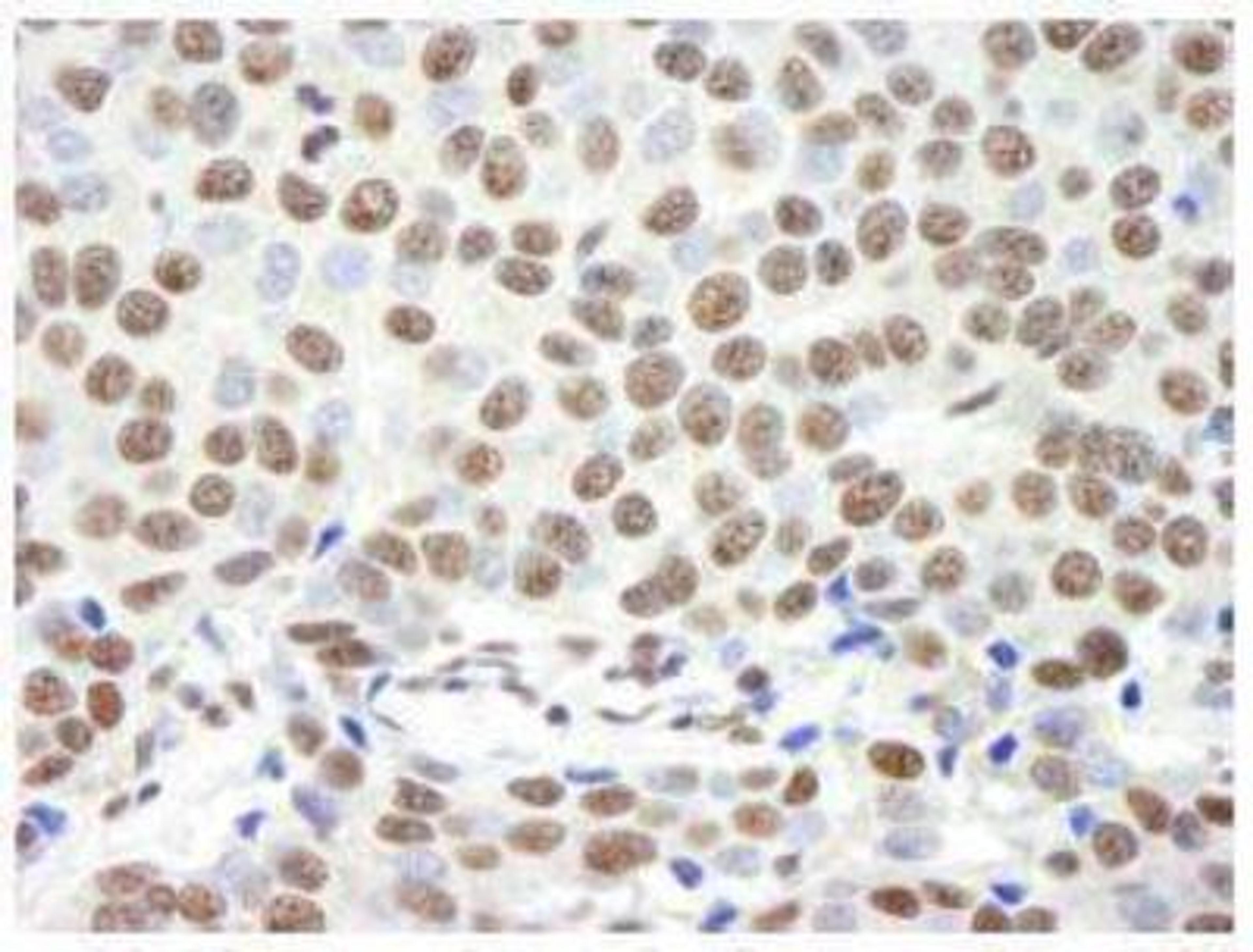 Immunohistochemistry-Paraffin: Timeless Antibody [NB100-40853] - FFPE section of human breast carcinoma.  Affinity purified rabbit anti-Timeless used at a dilution of 1:250. Detection: DAB staining using Immunohistochemistry Accessory Kit