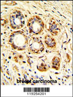 Formalin-fixed and paraffin-embedded human breast carcinoma with, which was peroxidase-conjugated to the secondary antibody, followed by DAB staining.