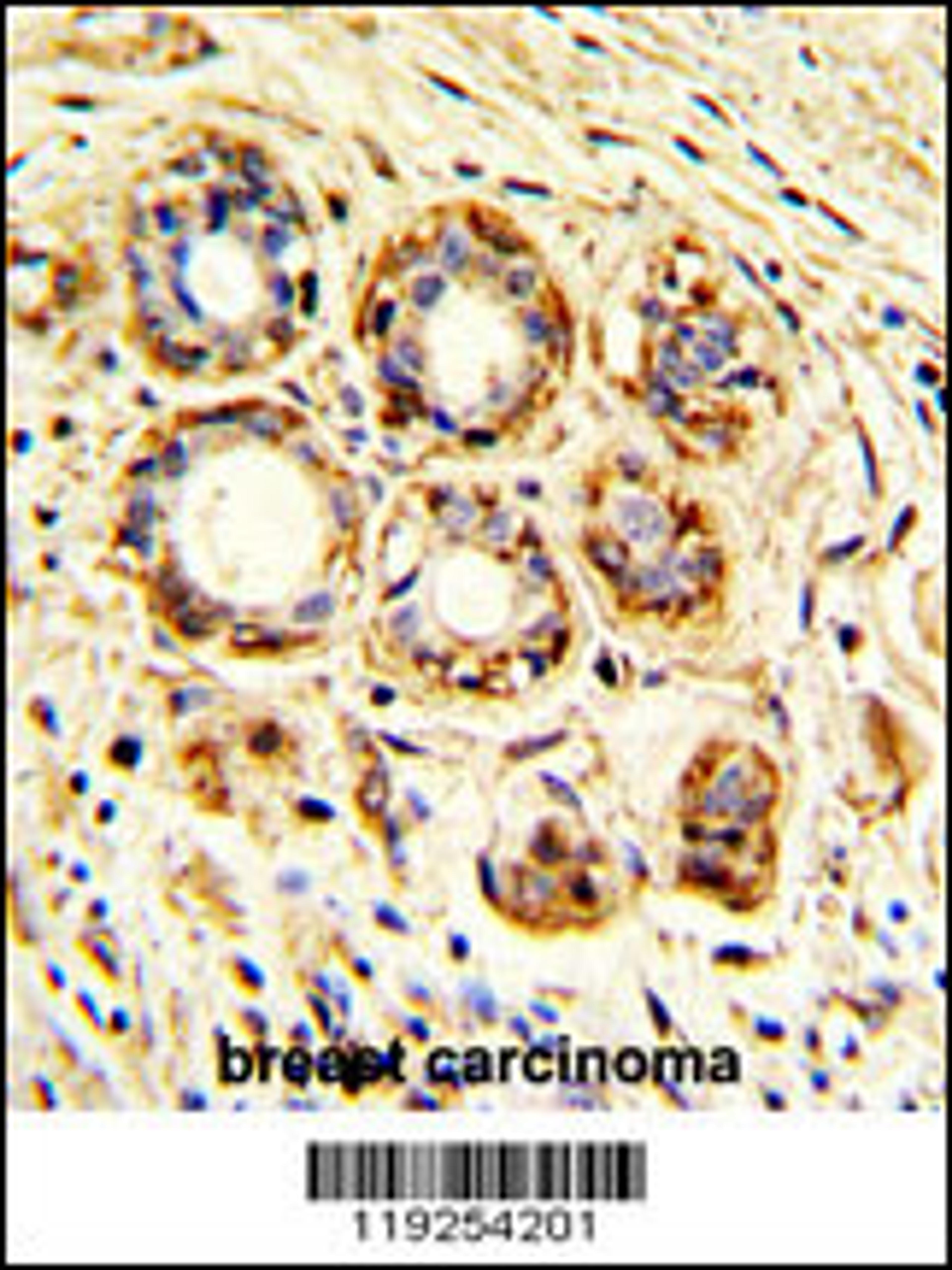 Formalin-fixed and paraffin-embedded human breast carcinoma with, which was peroxidase-conjugated to the secondary antibody, followed by DAB staining.