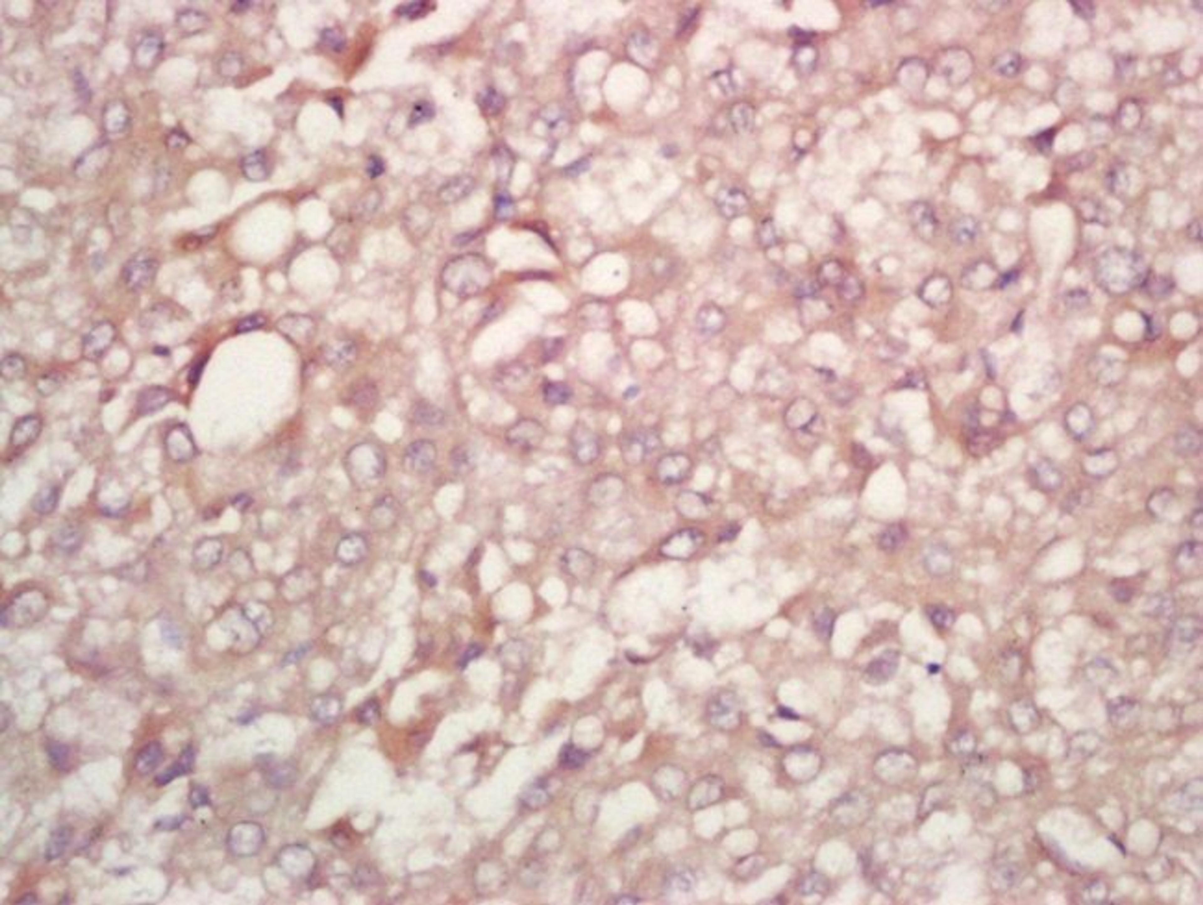 Immunohistochemical staining of human liver carcinoma tissue using PFK2 (phospho-Ser467) antibody