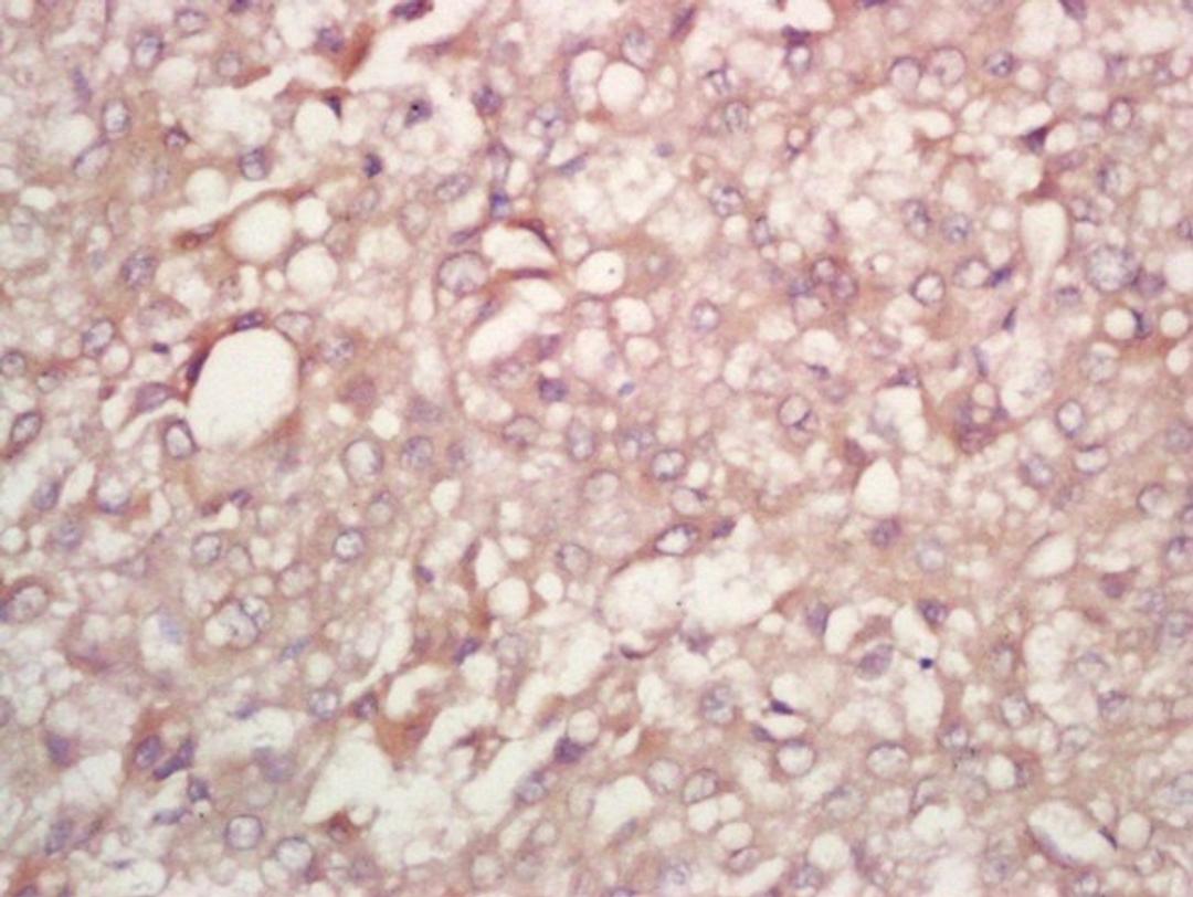 Immunohistochemical staining of human liver carcinoma tissue using PFK2 (phospho-Ser467) antibody