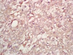 Immunohistochemical staining of human liver carcinoma tissue using PFK2 (phospho-Ser467) antibody