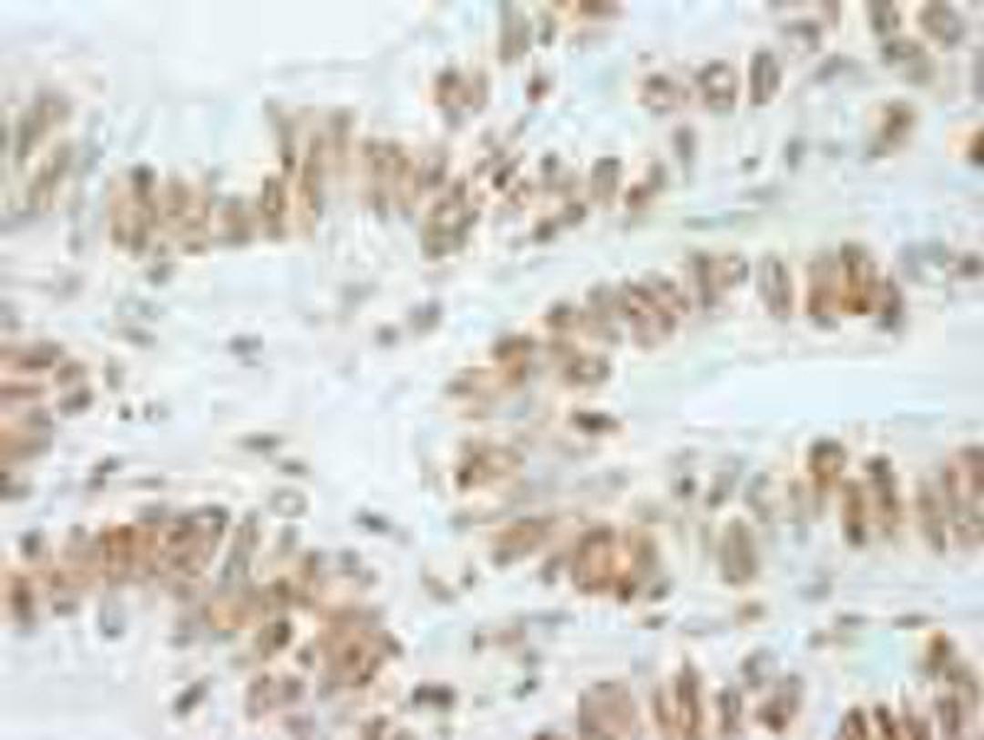 Immunohistochemistry-Paraffin: RbBP5 Antibody [NB600-252] - FFPE section of human colon adenocarcinoma.   Affinity purified rabbit anti-RbBP5 used at a dilution of 1:250.  Detection: DAB staining using Immunohistochemistry Accessory Kit