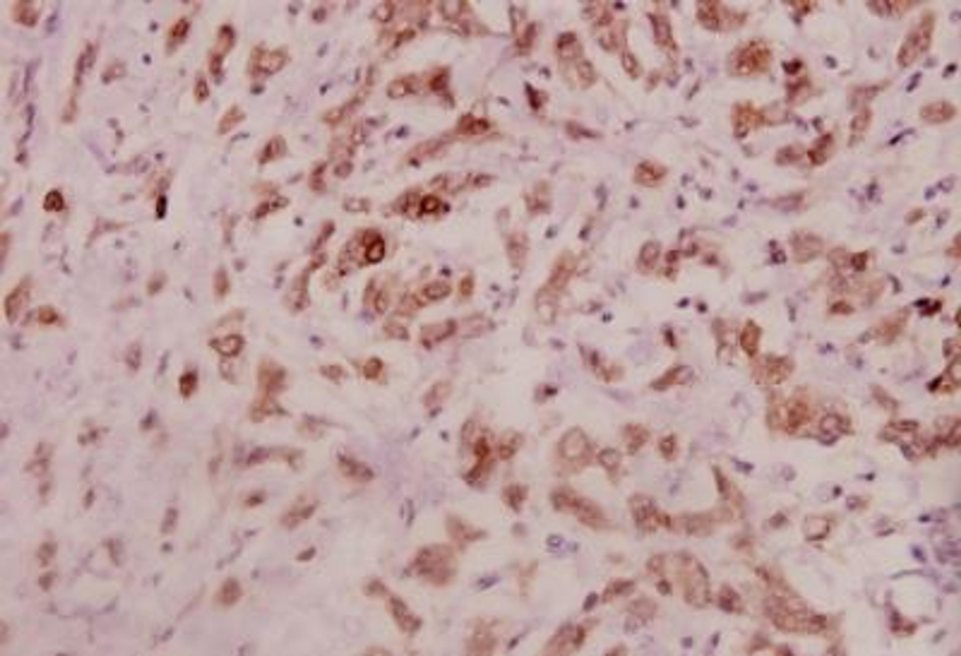 Immunohistochemistry-Paraffin: IL-11 Antibody [NBP1-19815] - Paraffin-embedded human breast carcinoma tissue at 1:100.