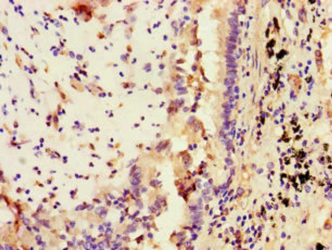 Immunohistochemistry of paraffin-embedded human lung cancer using CSB-PA022811LA01HU at dilution of 1:100