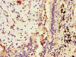 Immunohistochemistry of paraffin-embedded human lung cancer using CSB-PA022811LA01HU at dilution of 1:100
