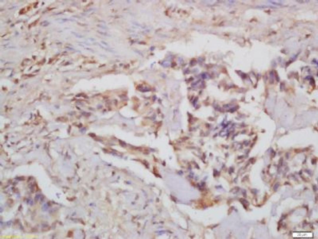 Immunohistochemical staining of human colon carcinoma tissue using CARD15 antibody.