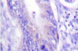 Immunohistochemistry: WASF1/WAVE1 Antibody [NB100-92239] - Analyzes of WAVE1  (I119) antibody in paraffin-embedded human colon carcinoma brain tissue.