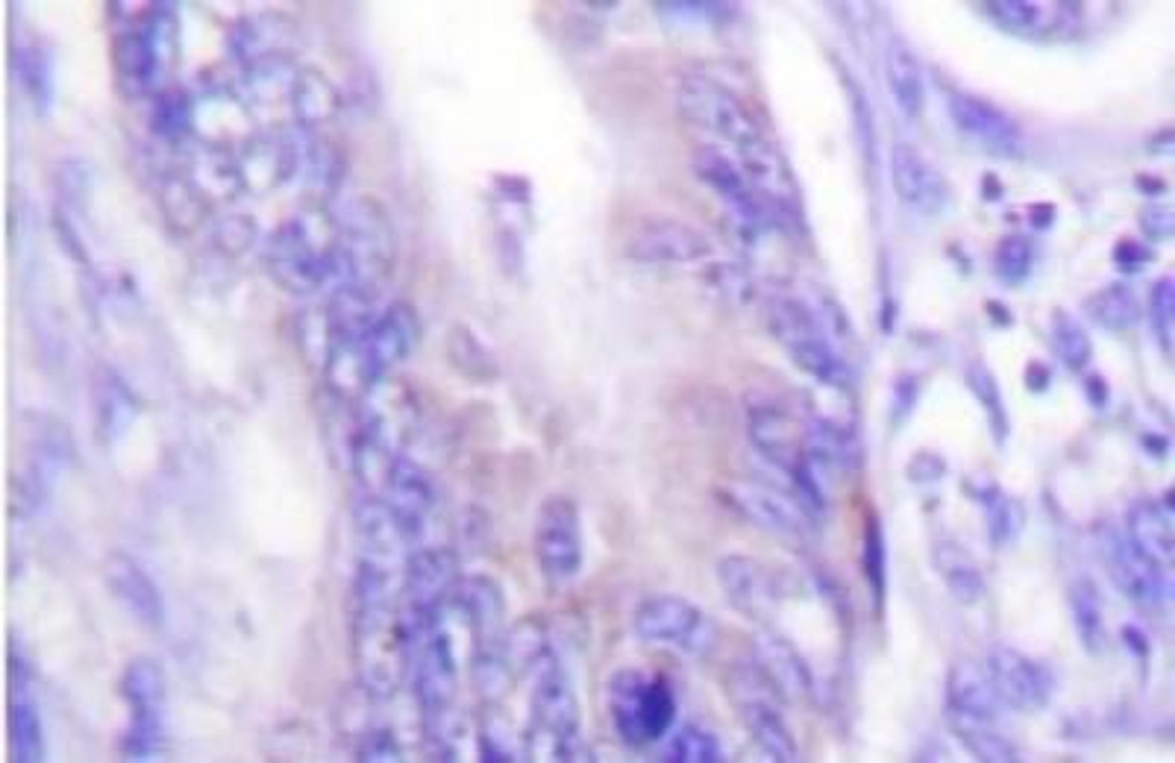 Immunohistochemistry: WASF1/WAVE1 Antibody [NB100-92239] - Analyzes of WAVE1  (I119) antibody in paraffin-embedded human colon carcinoma brain tissue.