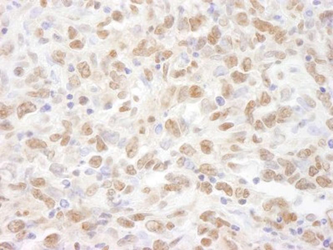 Immunohistochemistry-Paraffin: MED1 Antibody [NB100-2574] - Human metastatic lymph node.  Antibody used at a dilution of 1:1000 (1ug/ml).