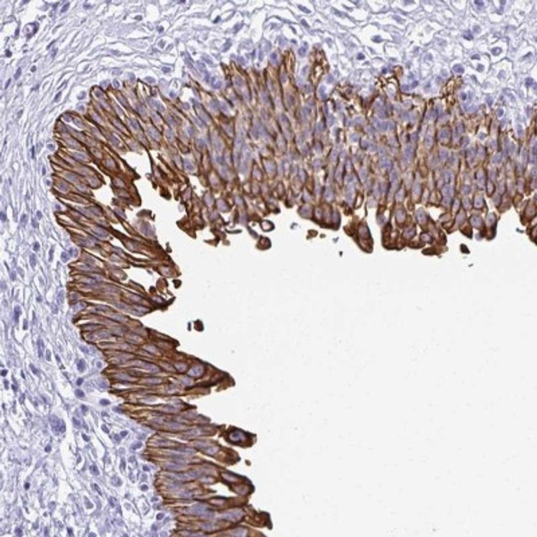 Immunohistochemistry: CPEB1 Antibody [NBP2-32350] - Staining of human urinary bladder shows strong membranous and cytoplasmic positivity in urothelial cells.