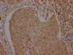 IHC image of CSB-PA002277LA01HU diluted at 1:100 and staining in paraffin-embedded human cervical cancer performed on a Leica BondTM system. After dewaxing and hydration, antigen retrieval was mediated by high pressure in a citrate buffer (pH 6.0). Section was blocked with 10% normal goat serum 30min at RT. Then primary antibody (1% BSA) was incubated at 4°C overnight. The primary is detected by a Goat anti-rabbit polymer IgG labeled by HRP and visualized using 0.05% DAB.