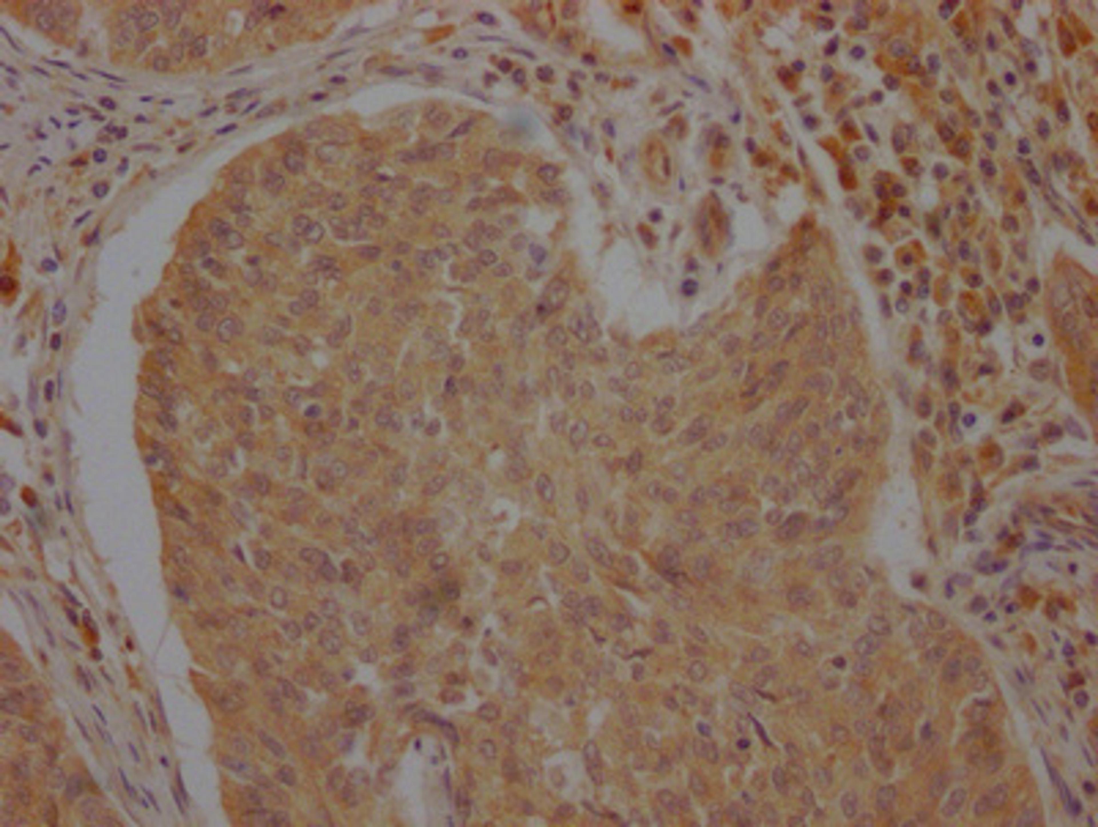 IHC image of CSB-PA002277LA01HU diluted at 1:100 and staining in paraffin-embedded human cervical cancer performed on a Leica BondTM system. After dewaxing and hydration, antigen retrieval was mediated by high pressure in a citrate buffer (pH 6.0). Section was blocked with 10% normal goat serum 30min at RT. Then primary antibody (1% BSA) was incubated at 4°C overnight. The primary is detected by a Goat anti-rabbit polymer IgG labeled by HRP and visualized using 0.05% DAB.