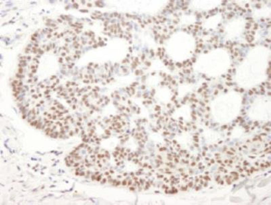 Immunohistochemistry: BCL11B Antibody [NB100-2600] - Section of human skin tumor. Antibody: Affinity  purified rabbit anti-Bcl11b (NB100-2600) used at a  dilution of 1:500. Detection: DAB staining using anti-Rabbit  IHC antibody at a dilution of 1:100.