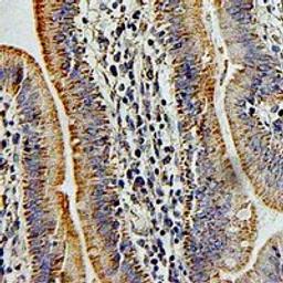 Immunohistochemical staining of human colon cancer tissue using PSG1 antibody