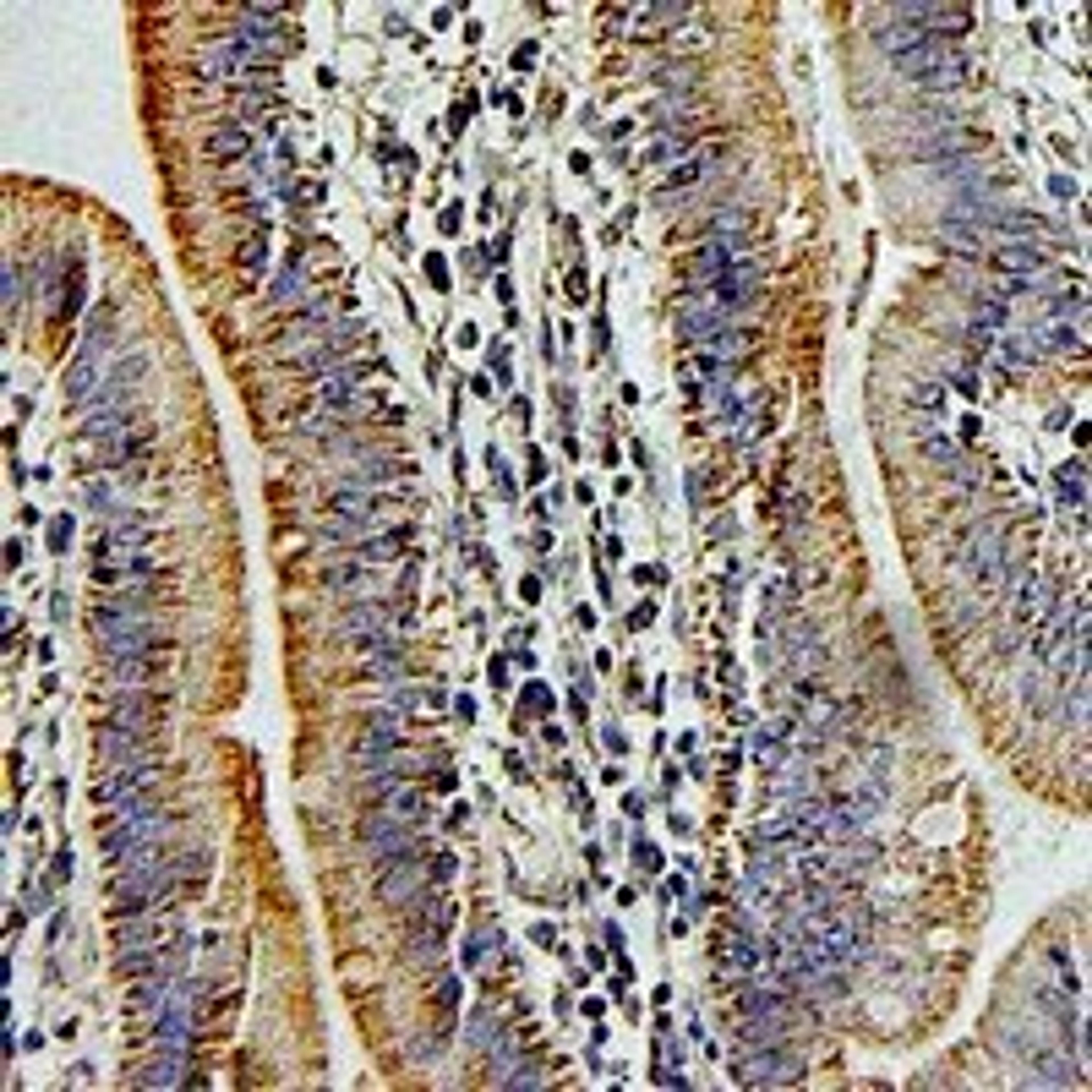 Immunohistochemical staining of human colon cancer tissue using PSG1 antibody