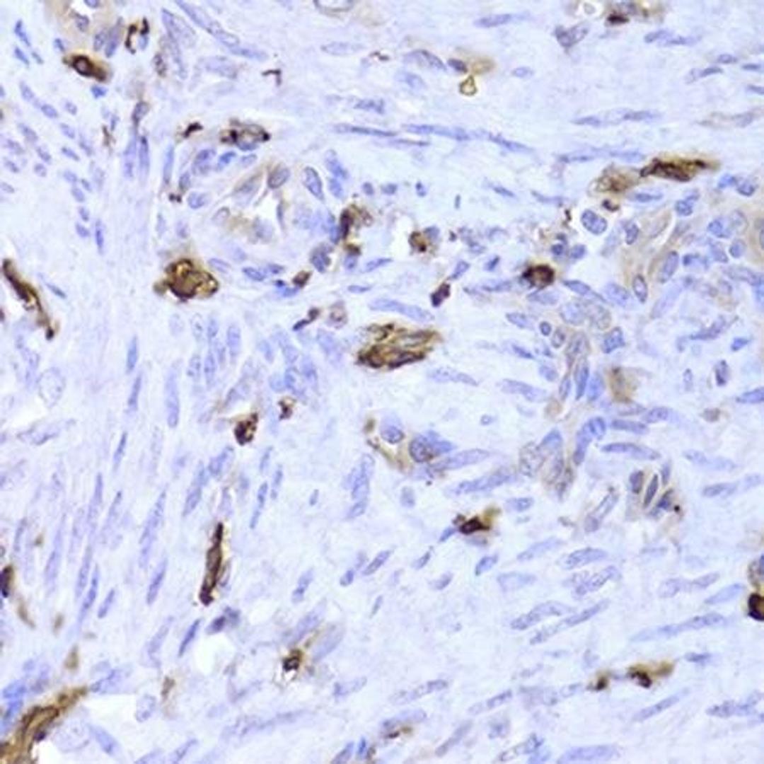 Immunohistochemical staining of human adenomyosis tissue using LSP1 antibody