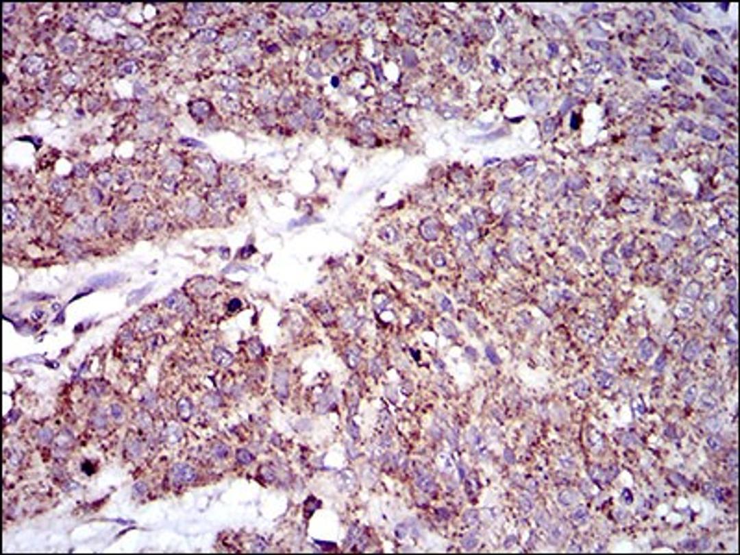 Immunohistochemistry: MRPL42 Antibody (3H6G11) [NBP2-37393] - Immunohistochemical analysis of paraffin-embedded esophageal cancer tissues using MRPL42 mouse mAb with DAB staining.