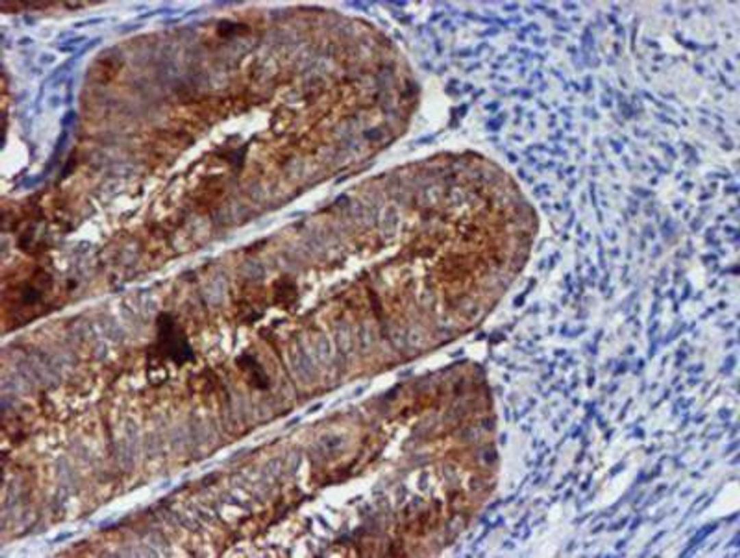 Immunohistochemistry-Paraffin: Cystatin C Antibody (2C8) [NBP2-01875] - Staining of paraffin-embedded Adenocarcinoma of Human endometrium tissue using anti-Cystatin C mouse monoclonal antibody.