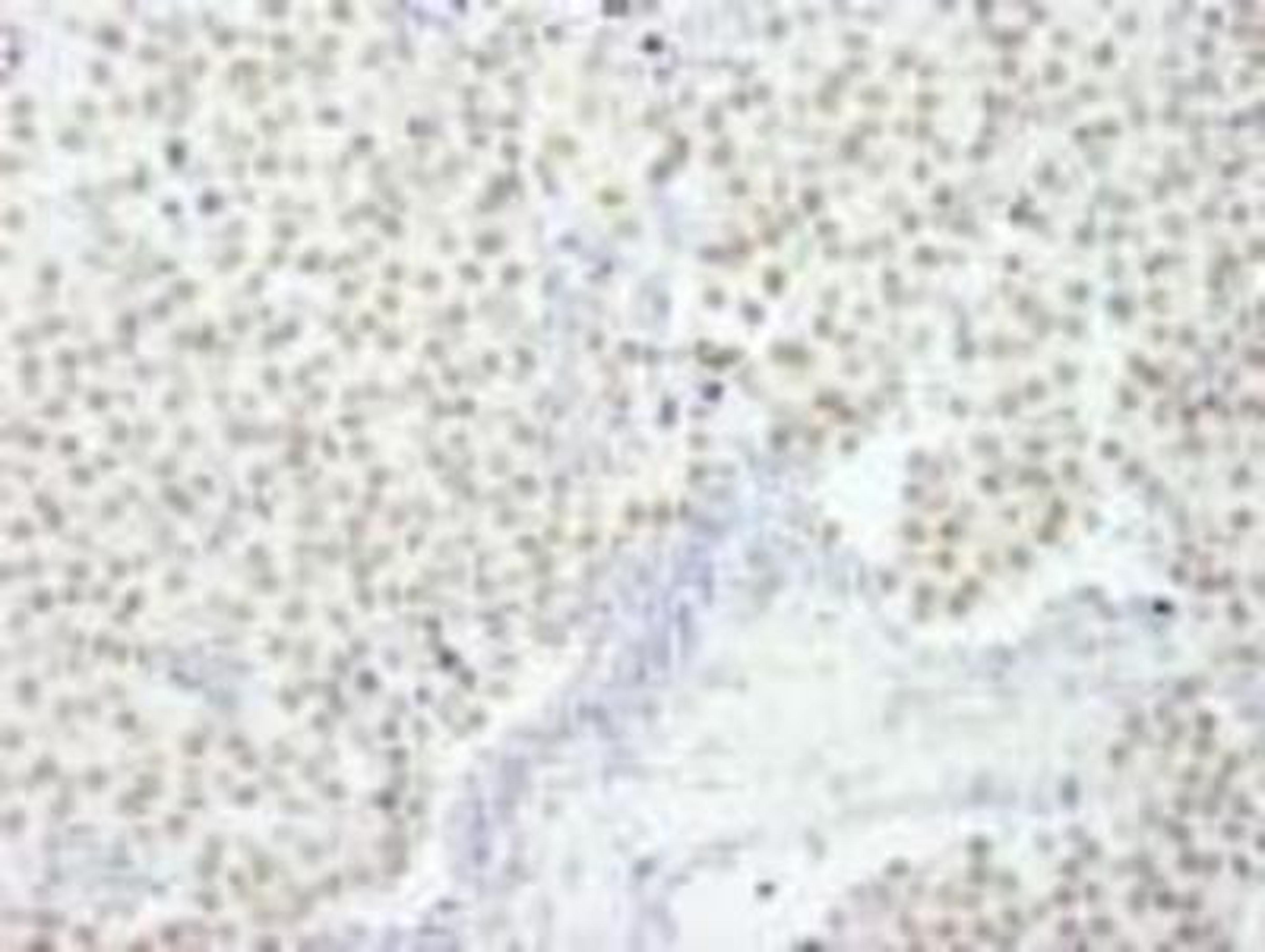 Immunohistochemistry-Paraffin: CoREST3/RCOR3 Antibody [NB100-60637] - FFPE section of human breast carcinoma.  Antibody at a dilution of 1:250.