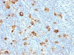 IHC testing of FFPE human Hodgkin's lymphoma and recombinant CD15 antibody (clone FUT4/1478R). HIER: steam sections in 10mM Tris with 1mM EDTA, pH 9.0, for 10-20 min.