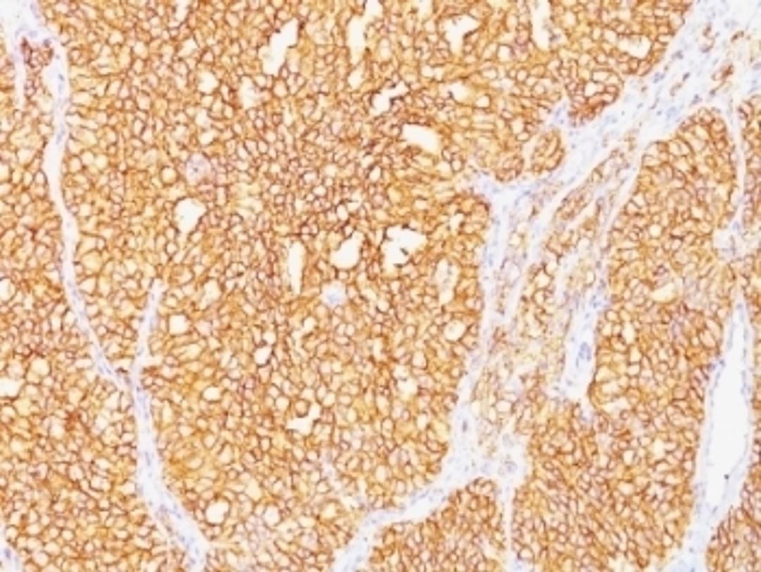 Formalin-fixed, paraffin-embedded human renal cell carcinoma stained with Carbonic Anhydrase IX antibody (SPM487).