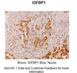 Antibody used in IHC on Human lung adenocarcinoma at 1:300.