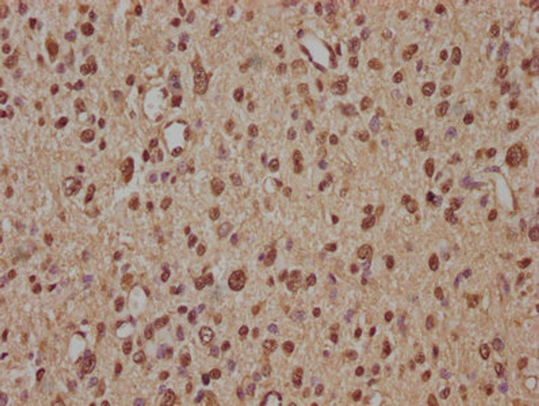 IHC image of CSB-PA026738OA01HU diluted at 1:100 and staining in paraffin-embedded human glioma performed on a Leica BondTM system. After dewaxing and hydration, antigen retrieval was mediated by high pressure in a citrate buffer (pH 6.0). Section was blocked with 10% normal goat serum 30min at RT. Then primary antibody (1% BSA) was incubated at 4&deg;C overnight. The primary is detected by a biotinylated secondary antibody and visualized using an HRP conjugated SP system.