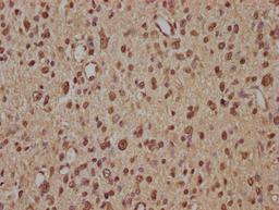 IHC image of CSB-PA026738OA01HU diluted at 1:100 and staining in paraffin-embedded human glioma performed on a Leica BondTM system. After dewaxing and hydration, antigen retrieval was mediated by high pressure in a citrate buffer (pH 6.0). Section was blocked with 10% normal goat serum 30min at RT. Then primary antibody (1% BSA) was incubated at 4&deg;C overnight. The primary is detected by a biotinylated secondary antibody and visualized using an HRP conjugated SP system.