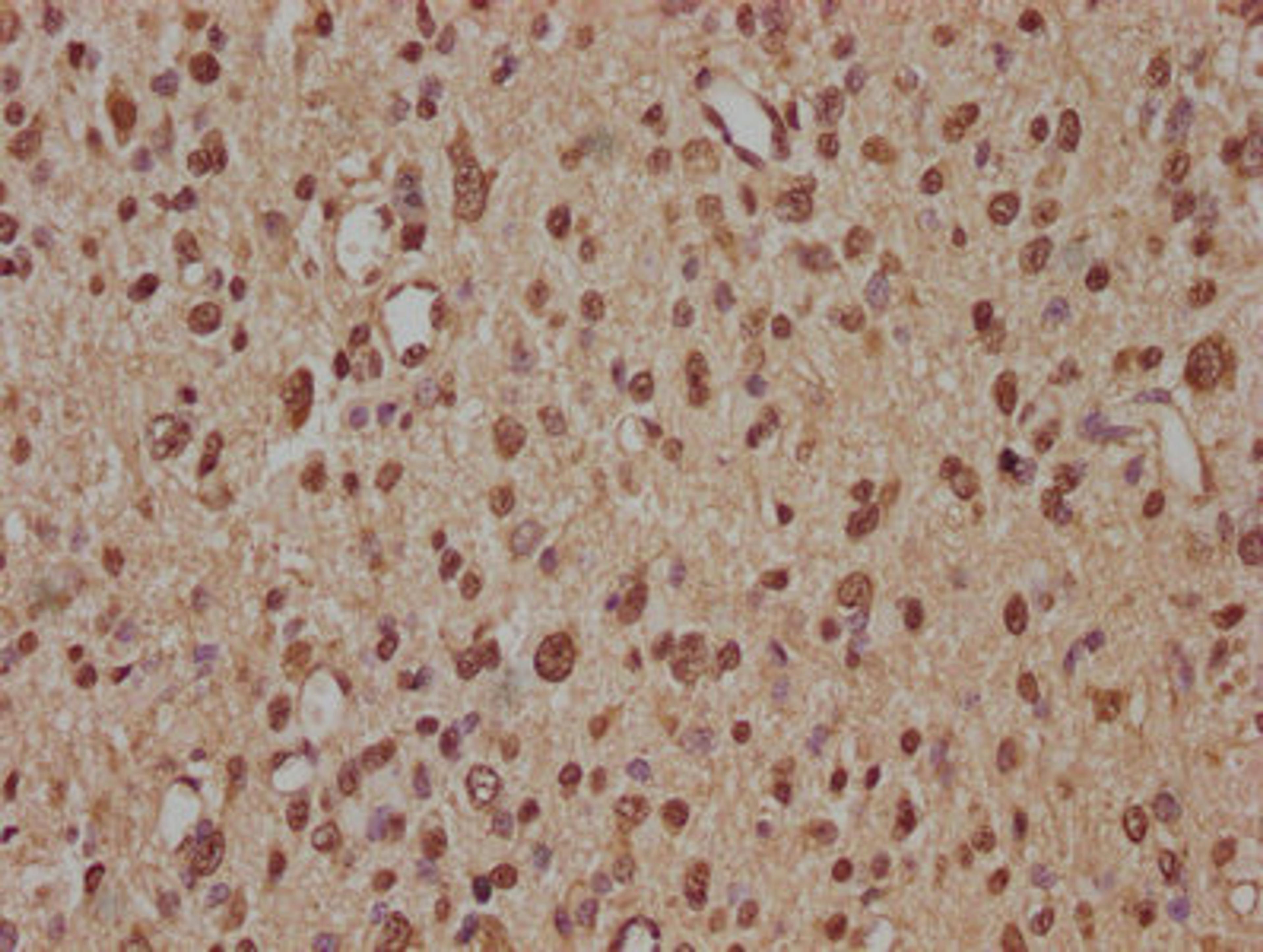IHC image of CSB-PA026738OA01HU diluted at 1:100 and staining in paraffin-embedded human glioma performed on a Leica BondTM system. After dewaxing and hydration, antigen retrieval was mediated by high pressure in a citrate buffer (pH 6.0). Section was blocked with 10% normal goat serum 30min at RT. Then primary antibody (1% BSA) was incubated at 4&deg;C overnight. The primary is detected by a biotinylated secondary antibody and visualized using an HRP conjugated SP system.