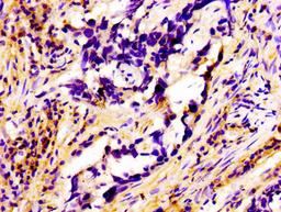 Immunohistochemistry of paraffin-embedded human pancreatic cancer using CSB-PA019194LA01HU at dilution of 1:100