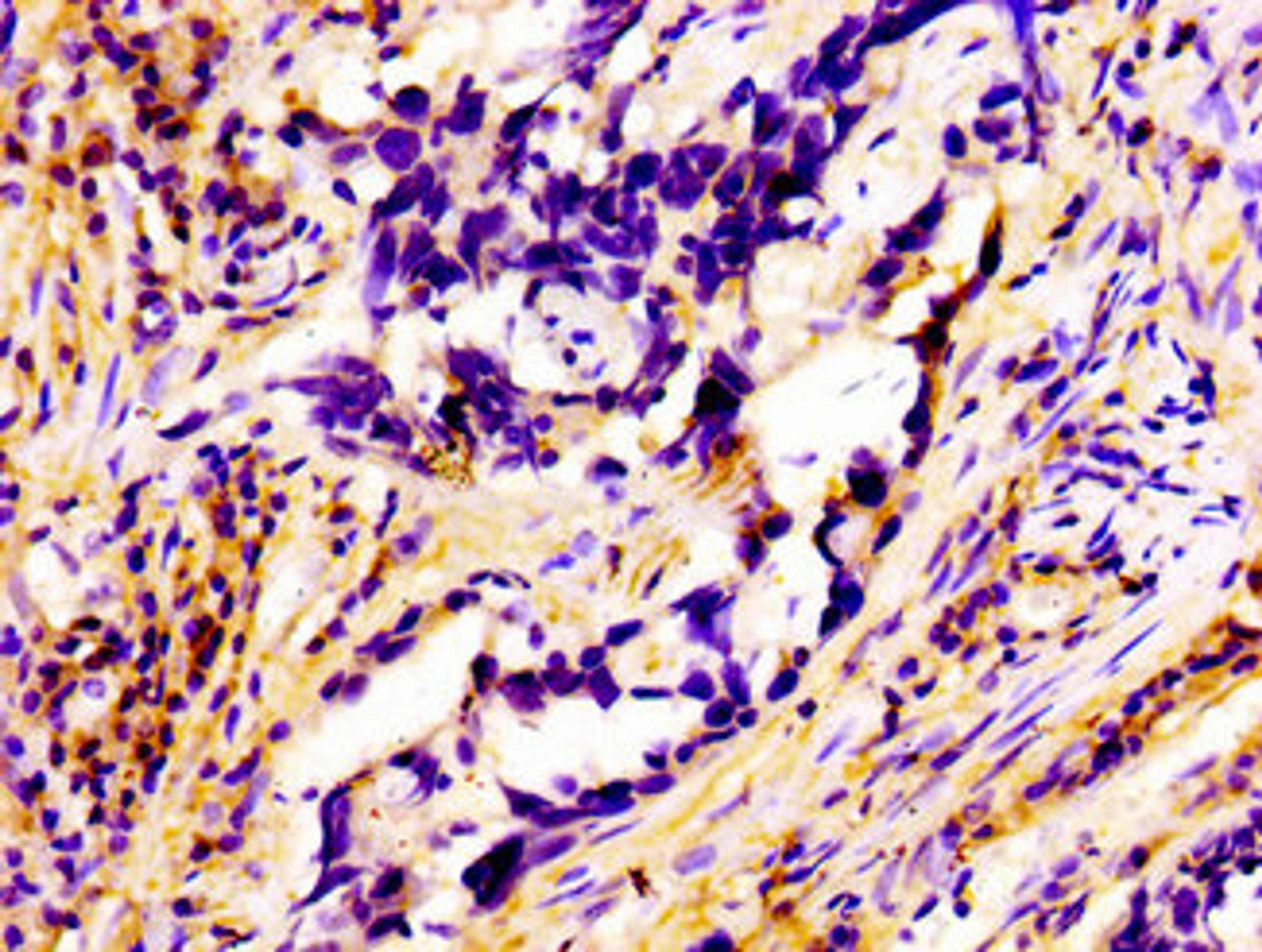 Immunohistochemistry of paraffin-embedded human pancreatic cancer using CSB-PA019194LA01HU at dilution of 1:100