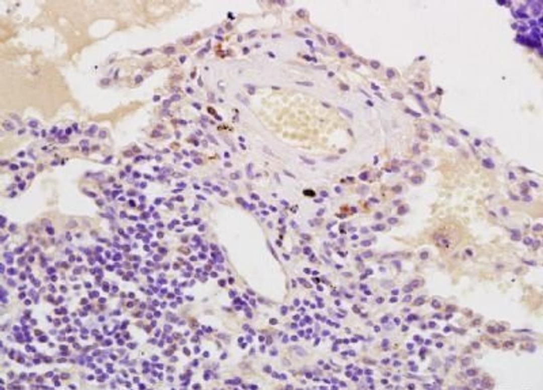 Immunohistochemical analysis of formalin-fixed paraffin embedded human lung carcinoma tissue using AIMP2 antibody (dilution at 1:200)