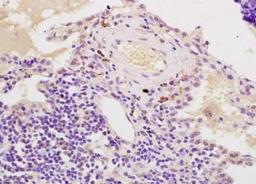 Immunohistochemical analysis of formalin-fixed paraffin embedded human lung carcinoma tissue using AIMP2 antibody (dilution at 1:200)