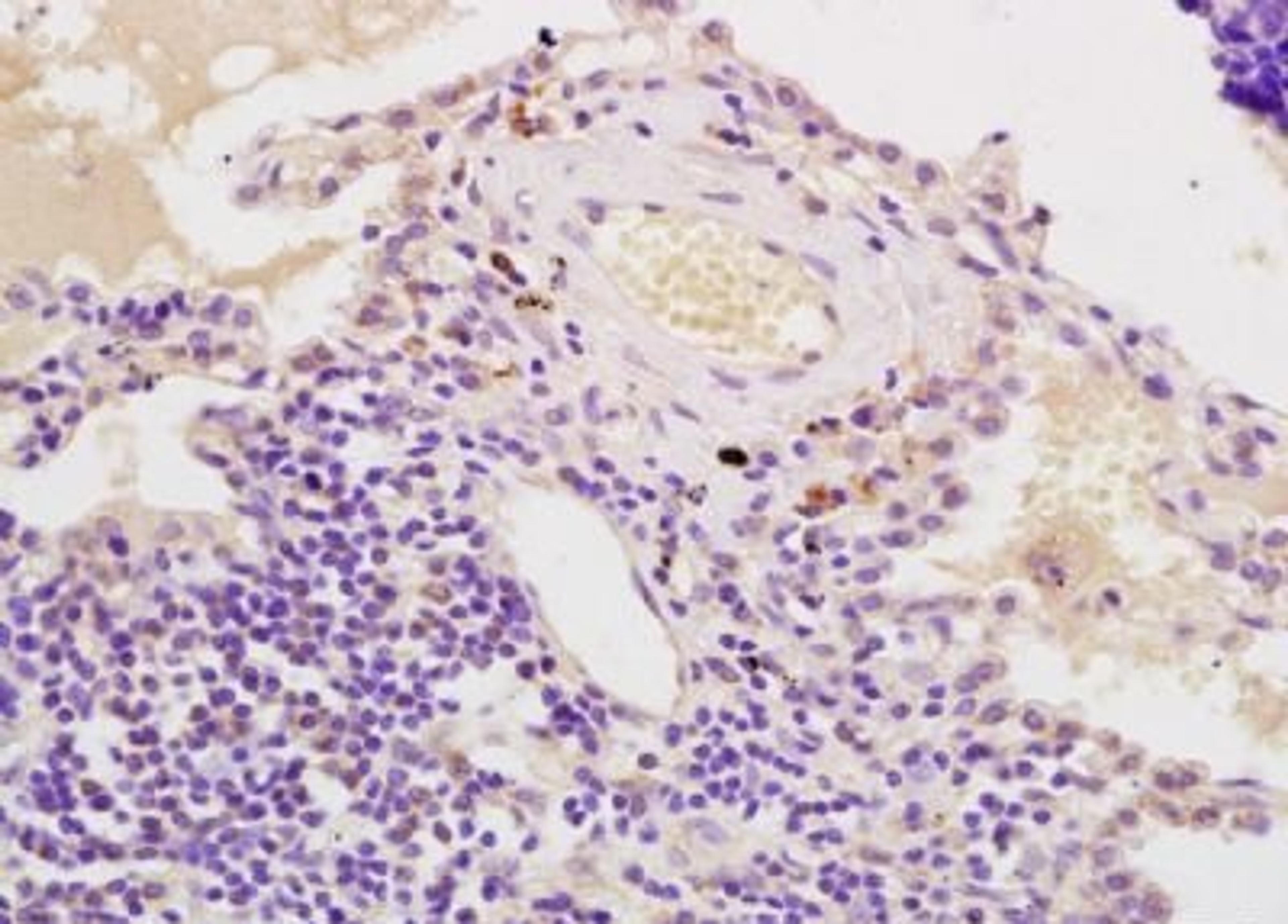 Immunohistochemical analysis of formalin-fixed paraffin embedded human lung carcinoma tissue using AIMP2 antibody (dilution at 1:200)