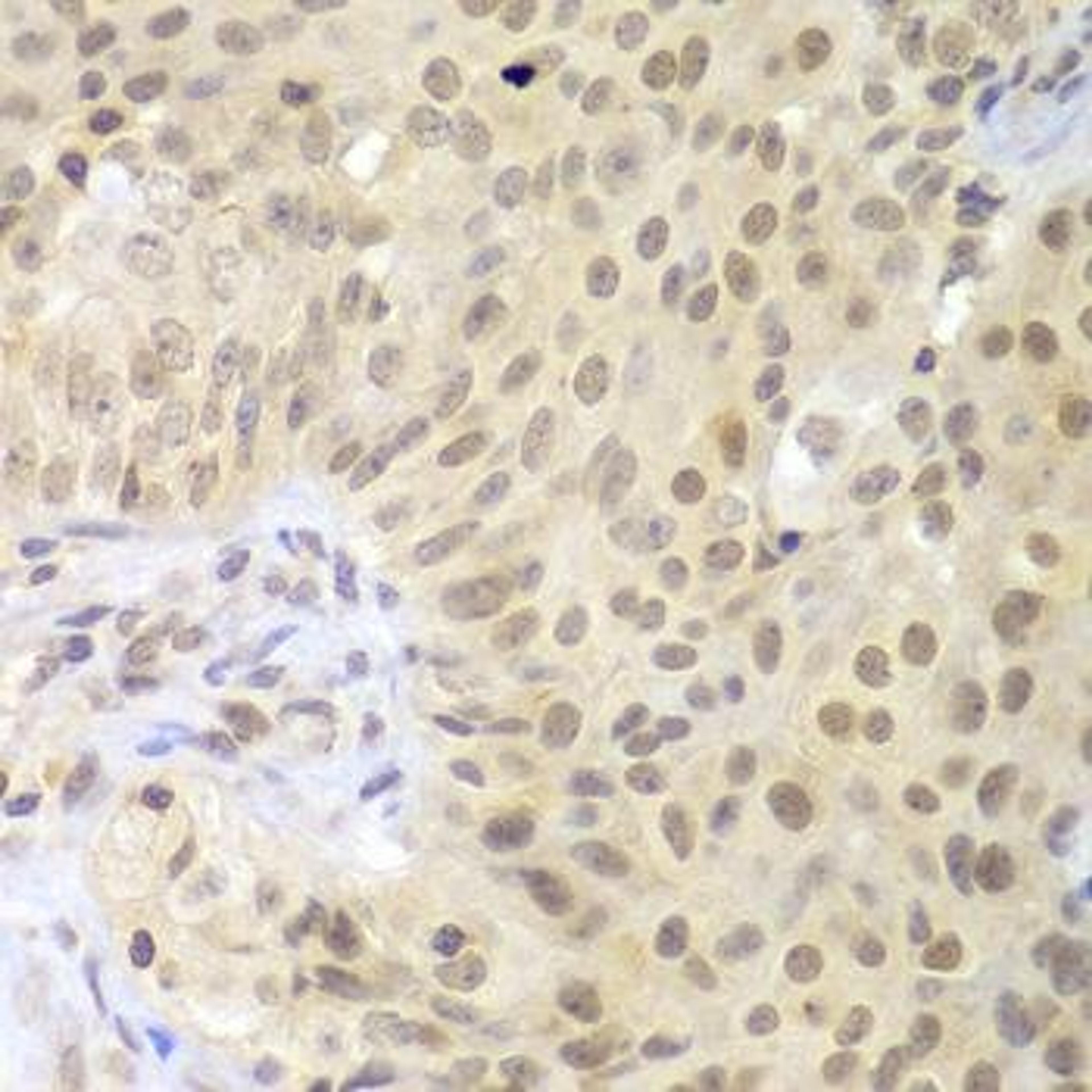 Immunohistochemical staining of human colon carcinoma tissue using LHX4 antibody (dilution of 1:100)