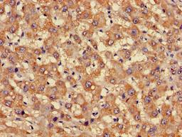 Immunohistochemistry of paraffin-embedded human liver cancer using CSB-PA008606LA01HU at dilution of 1:100
