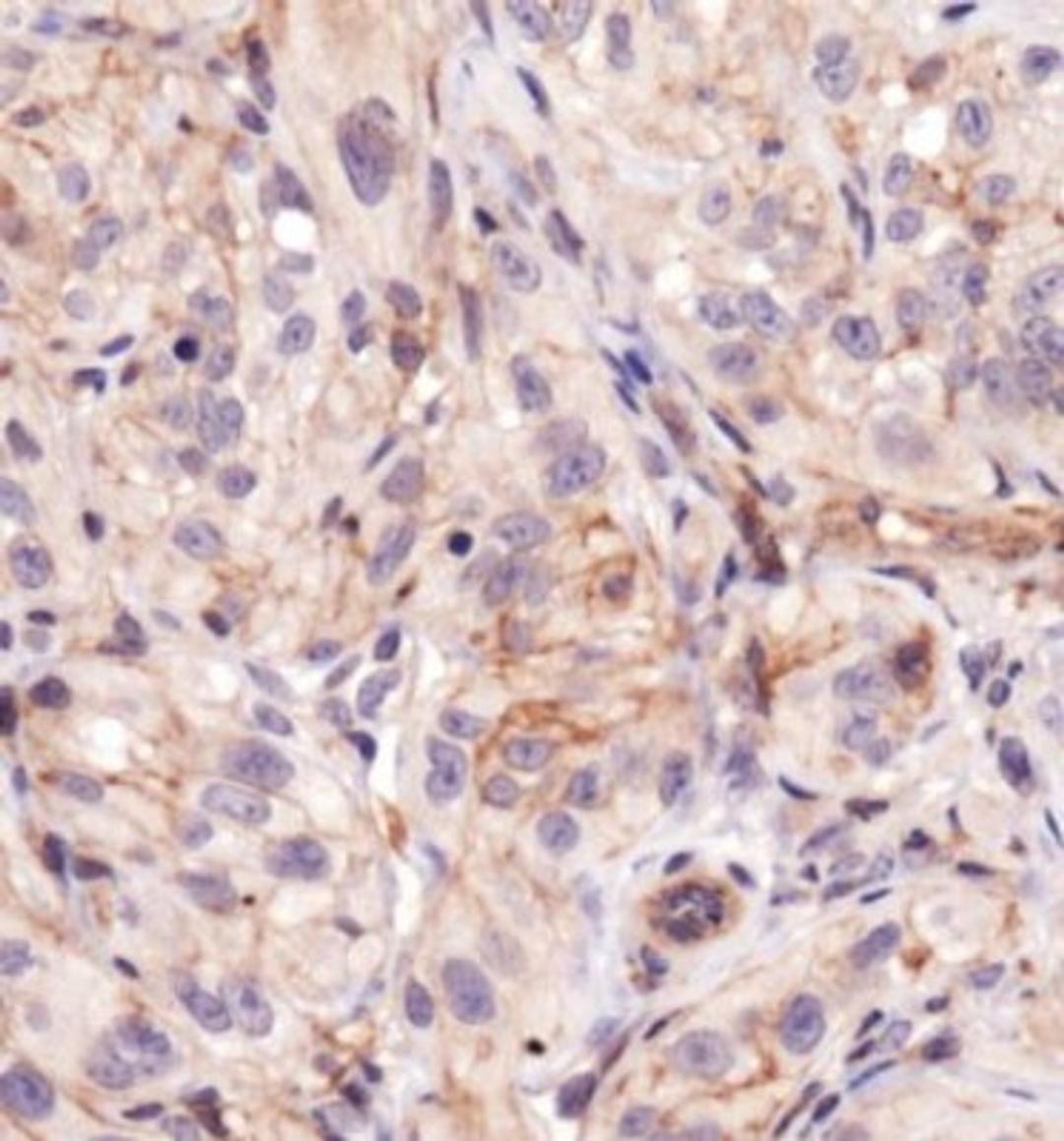 Immunohistochemistry: BTK [p Tyr223] Antibody [NBP1-78295] - IHC analysis of BTK in kidney cancer xenograft using DAB with hematoxylin counterstain.